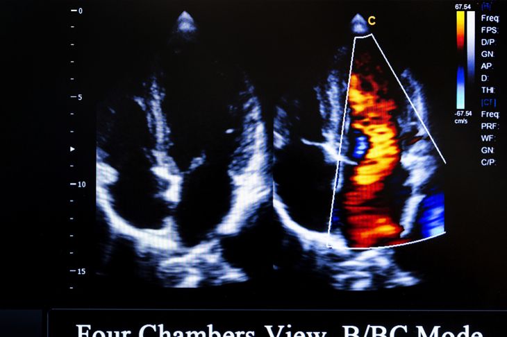 10 Frequently Asked Questions About an Echocardiogram