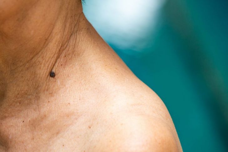 10 Signs of Skin Cancer