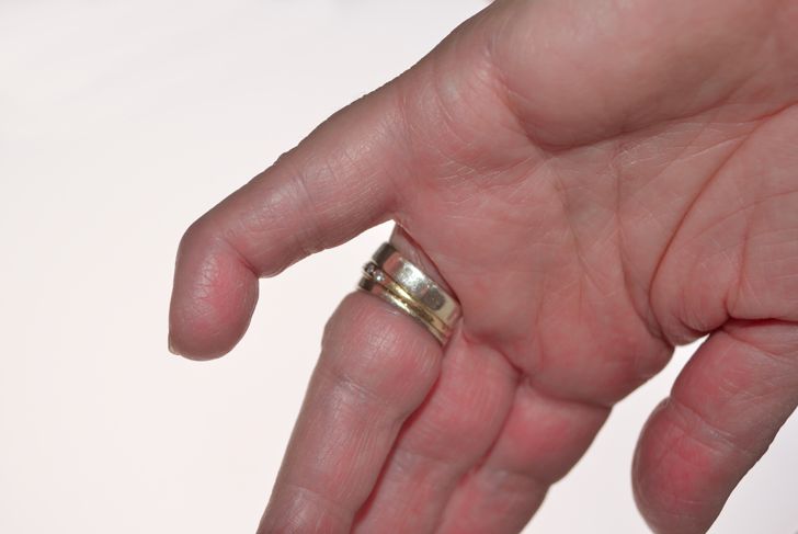 10 Symptoms and Treatments of Mallet Finger