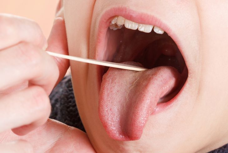 10 Symptoms of Strep Throat