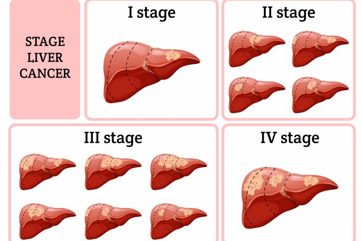 10 Treatments for Liver Cancer