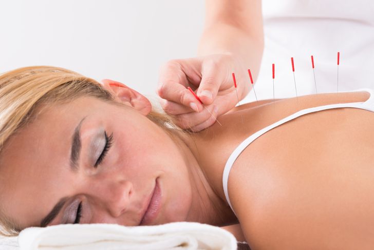 8 Health Benefits of Acupuncture