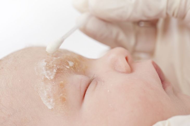 A Rash on Baby's Face: Wait It Out, or Worry?