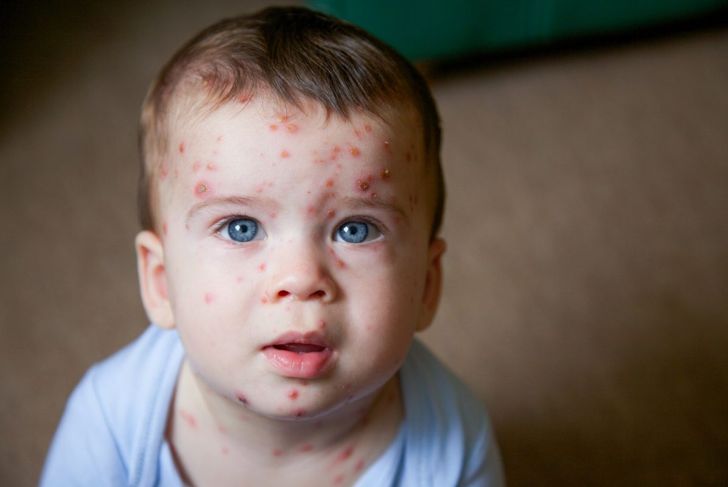 A Rash on Baby's Face: Wait It Out, or Worry?