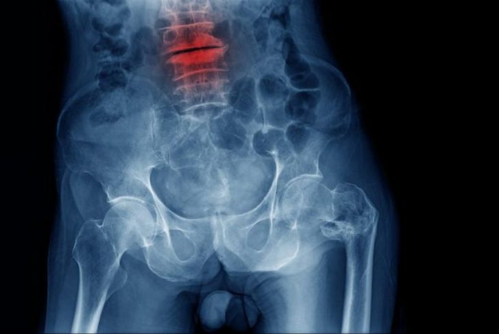 Back Pain? 10 Things to Know About Spondylosis