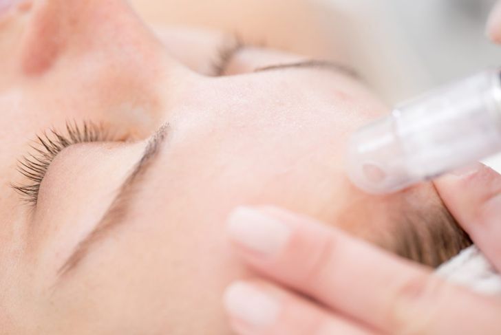 How Does Microdermabrasion Work?