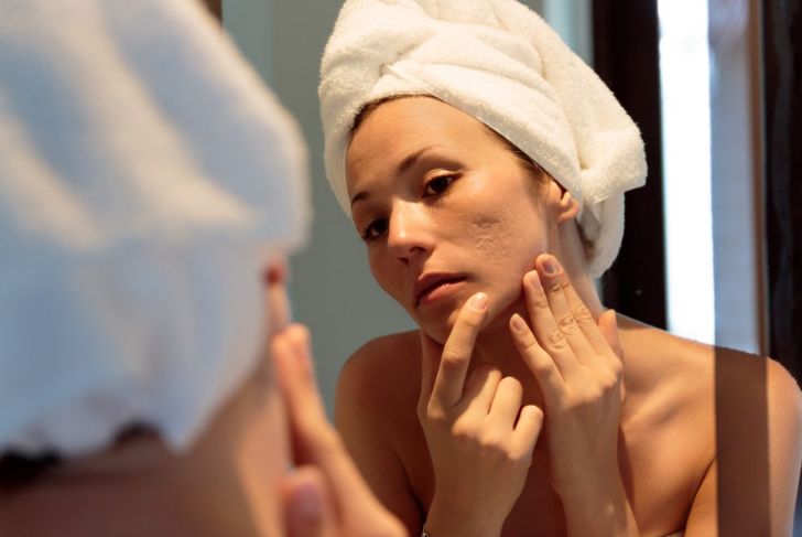 Reducing the Visibility of Acne Scars