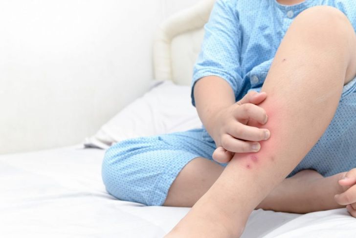 Symptoms and Treatments for Poison Ivy Rash