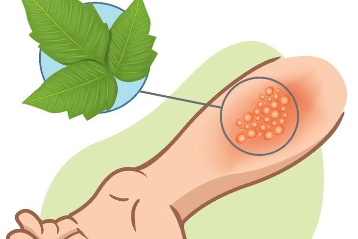 Symptoms and Treatments for Poison Ivy Rash