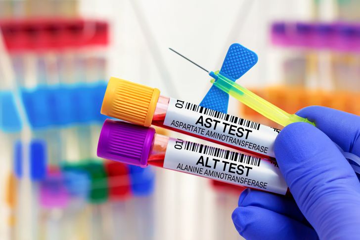 Understanding AST Blood Tests and Their Results
