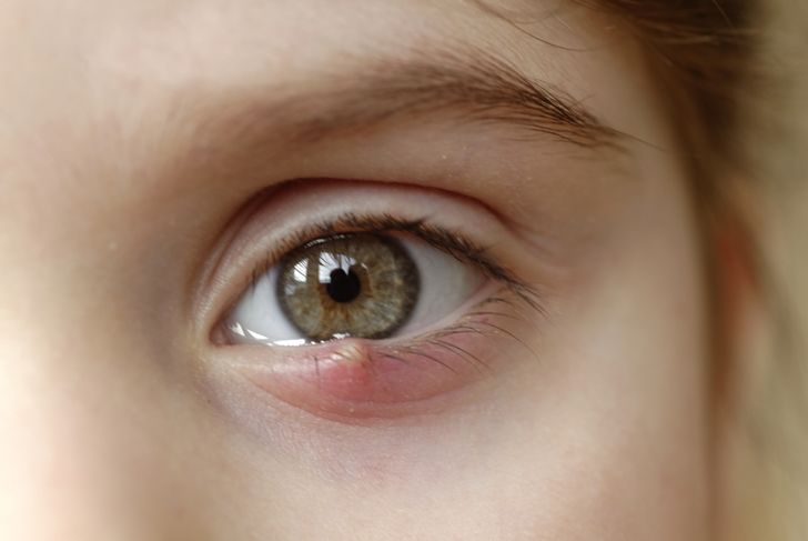 What Causes a Stye?