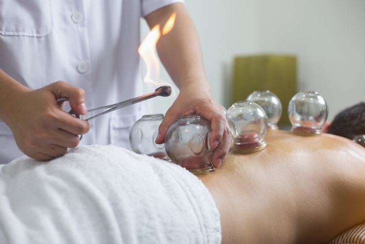 What Is Cupping Therapy?