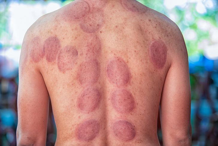 What Is Cupping Therapy?