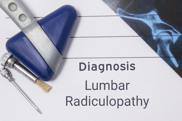 When Lower Back Pain is Lumbar Radiculopathy