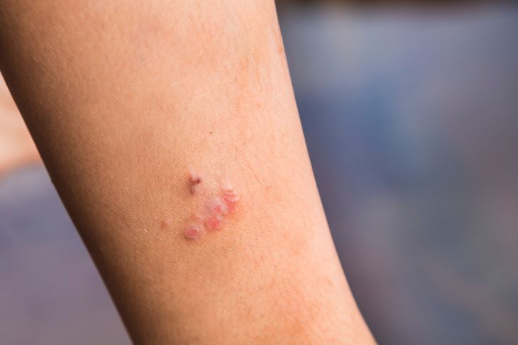 10 Causes and Symptoms of Petechiae