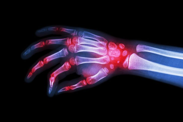 10 Causes of Arthritis