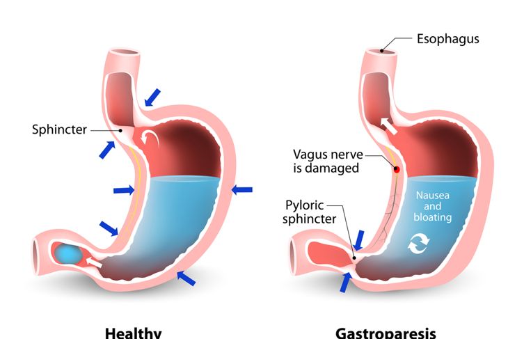10 Causes of Gastroparesis