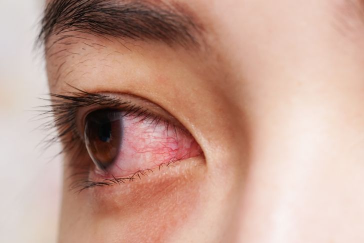 10 Causes of Glaucoma