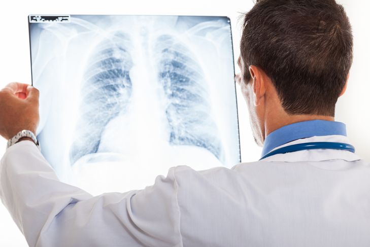 10 Causes of Lung Cancer
