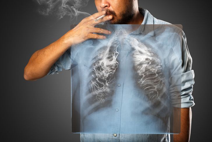 10 Causes of Lung Cancer