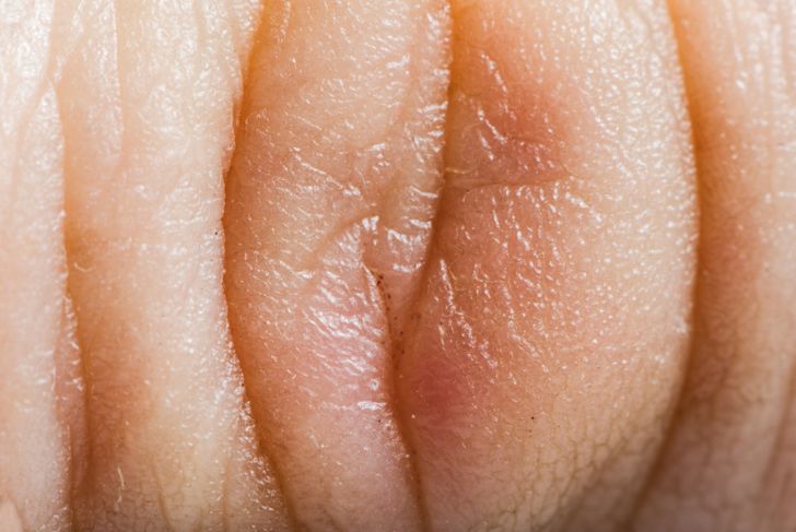 10 Causes of Ringworm