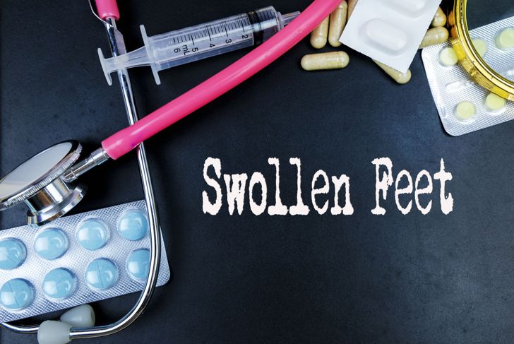 10 Causes of Swollen Feet