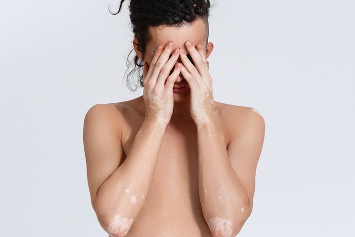 10 Causes of Vitiligo