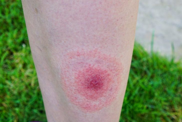 10 Causes, Risks, and Complications of Lyme Disease