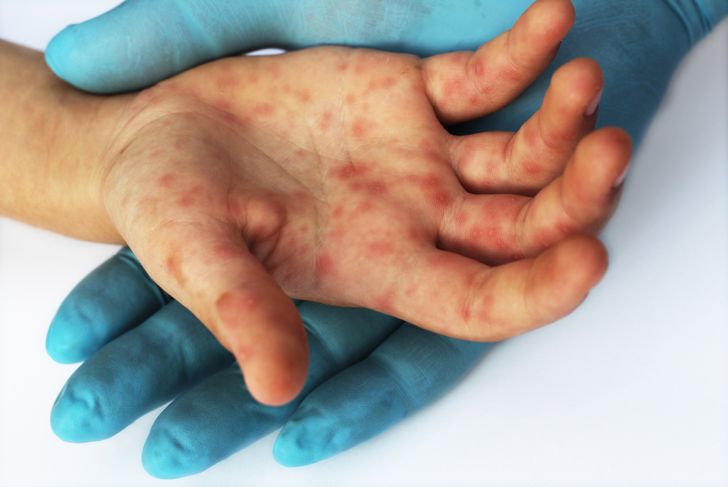 10 Causes, Symptoms, and Treatments of Hand-Foot-and-Mouth Disease