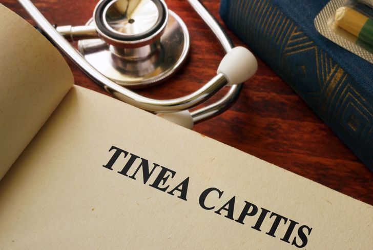 10 Causes, Symptoms, and Treatments of Tinea Capitis