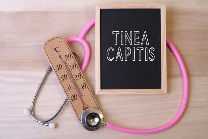 10 Causes, Symptoms, and Treatments of Tinea Capitis