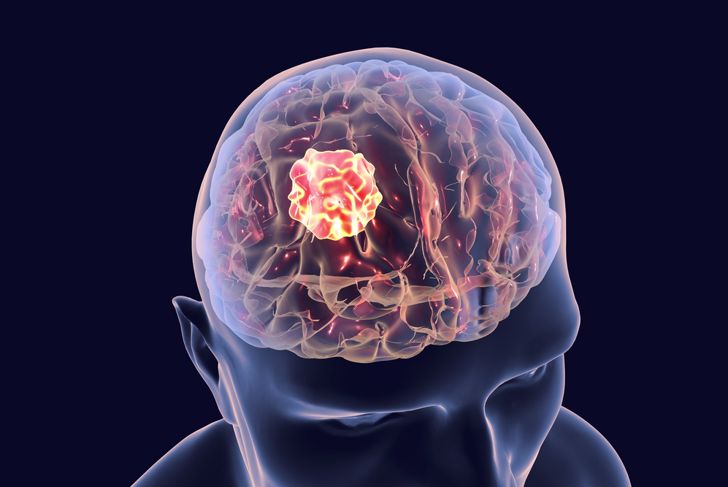 10 Common Brain Diseases