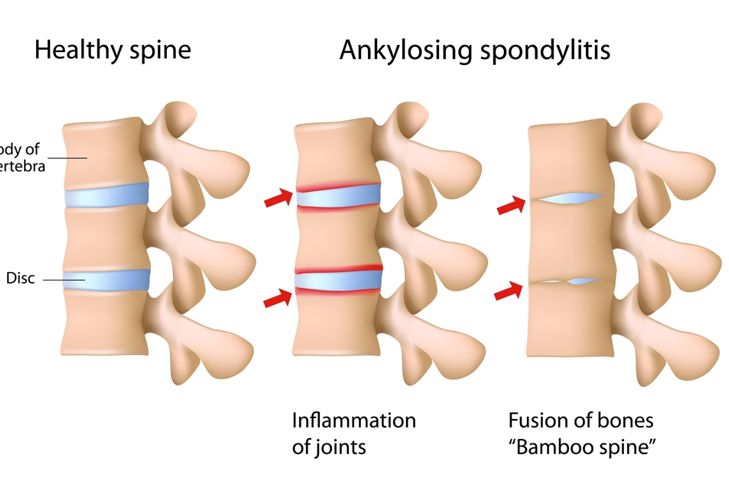 10 Common Symptoms of Ankylosing Spondylitis