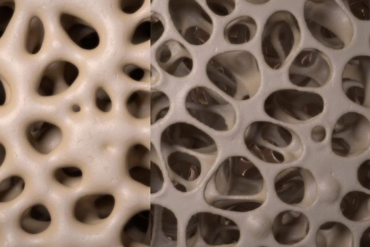 10 Facts About Bone Density Tests