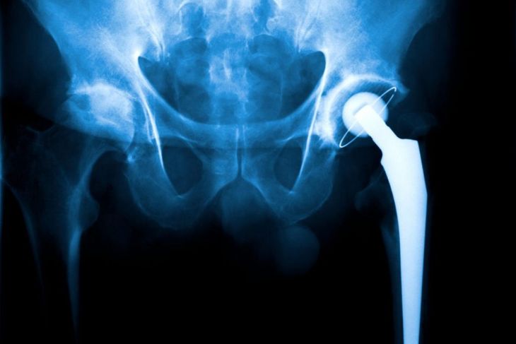 10 Facts About Hip Impingement