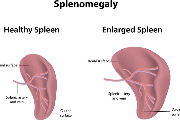 10 Facts About Splenomegaly