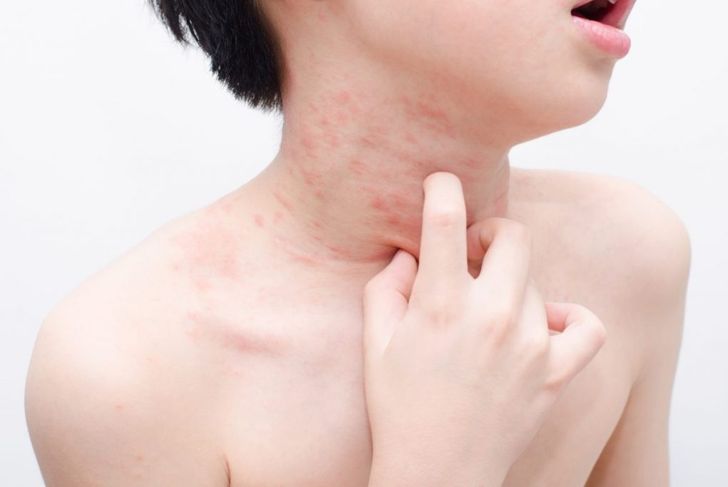 10 Frequently Asked Questions About Acute Urticaria