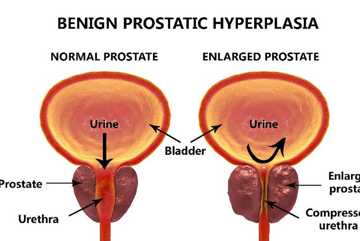 10 Frequently Asked Questions About Benign Prostate Enlargement