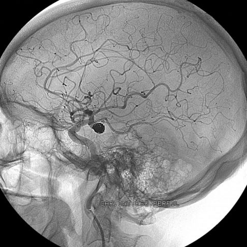 10 Frequently Asked Questions About Brain Aneurysms