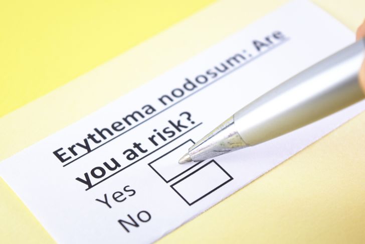 10 Frequently Asked Questions About Erythema Nodosum