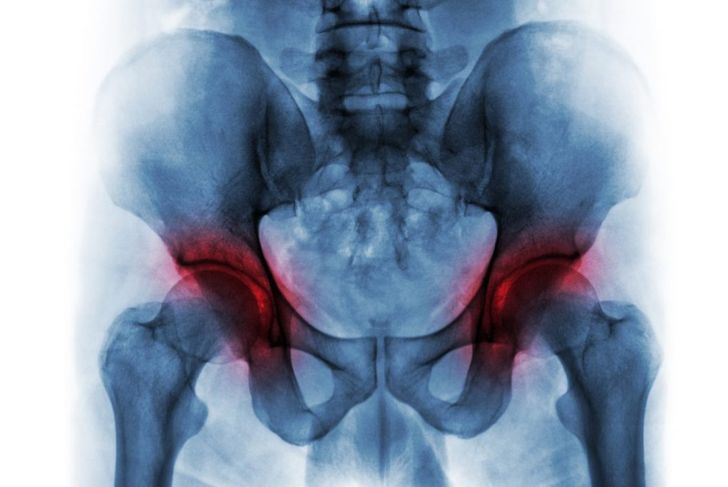 10 Frequently Asked Questions about Hip Dysplasia