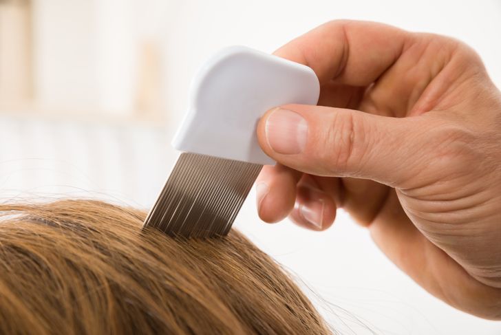 10 Home Remedies for Lice