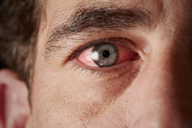 10 Home Remedies for Pink Eye