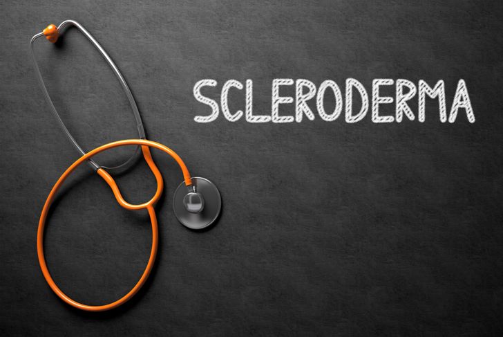 10 Important Symptoms of Scleroderma