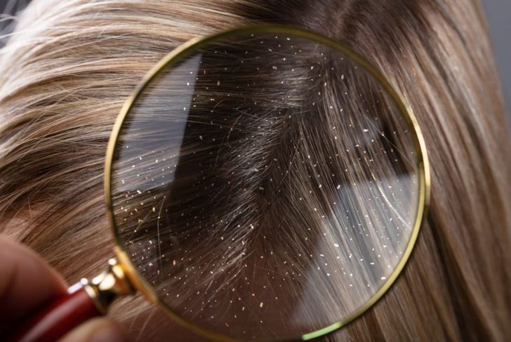 10 Most Common Causes of Scalp Infections