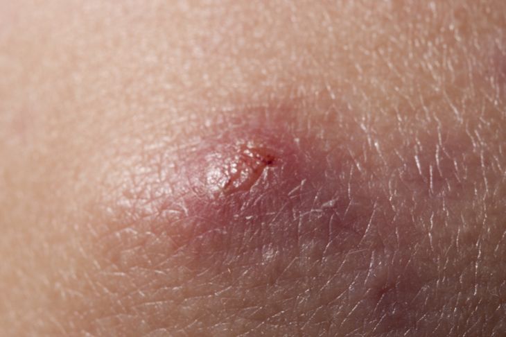 10 Possible Causes for Those Bumps on Your Skin