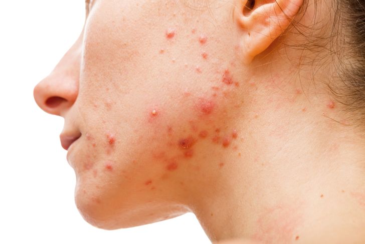 10 Possible Causes for Those Bumps on Your Skin