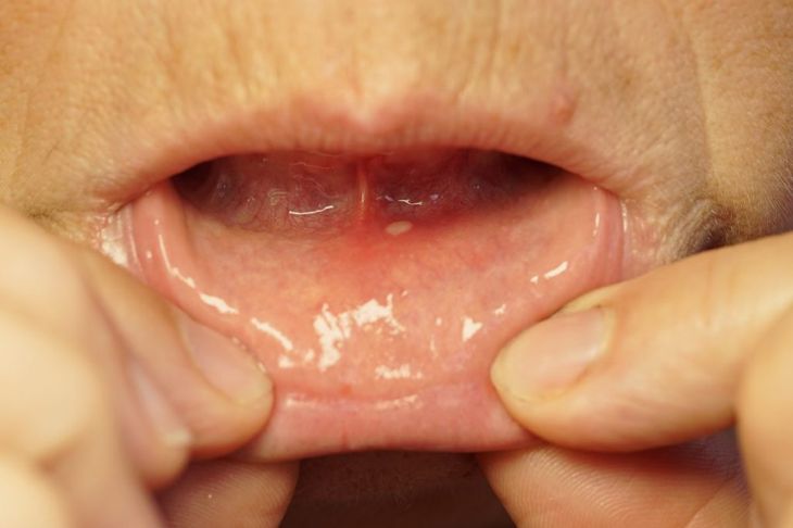 10 Primary Symptoms and Treatments of Dry Mouth Syndrome