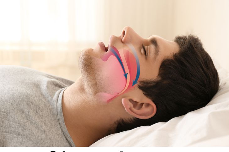 10 Recommended Treatments for Snoring