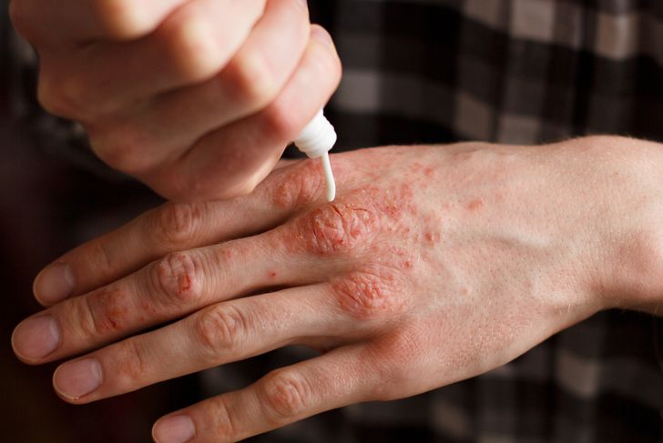 10 Remedies for Psoriasis